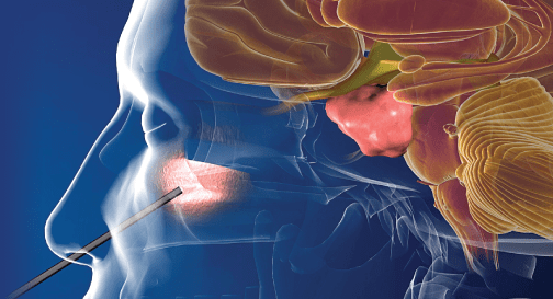 Treatment Of Pituitary Adenoma