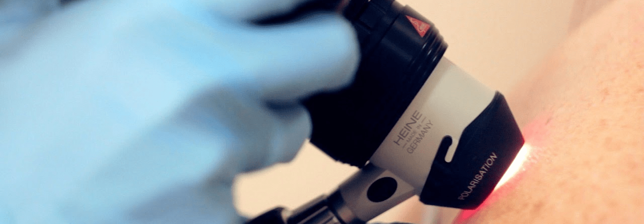 Where To Treat Melanoma And How Much Does It Cost?