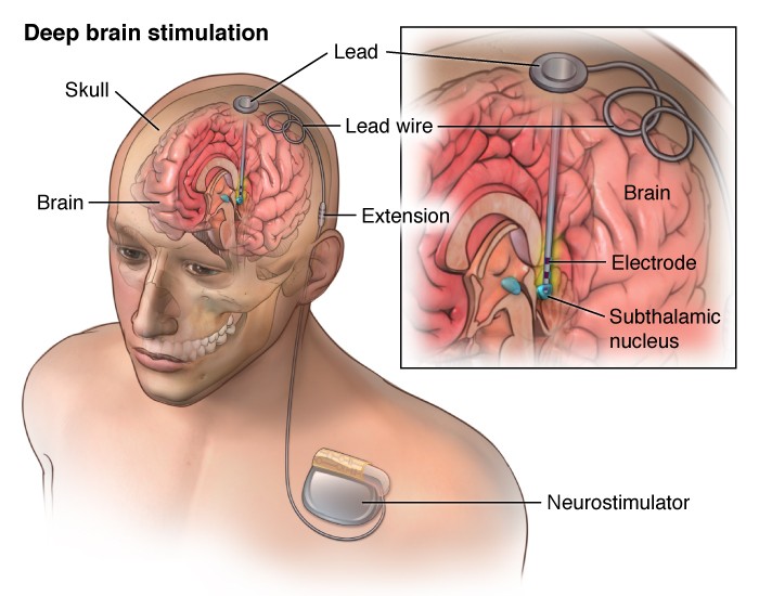 What Is Deep Brain Stimulation Surgery? Which Patients Are Eligible For DBS? Read The Procedure for DBS And More